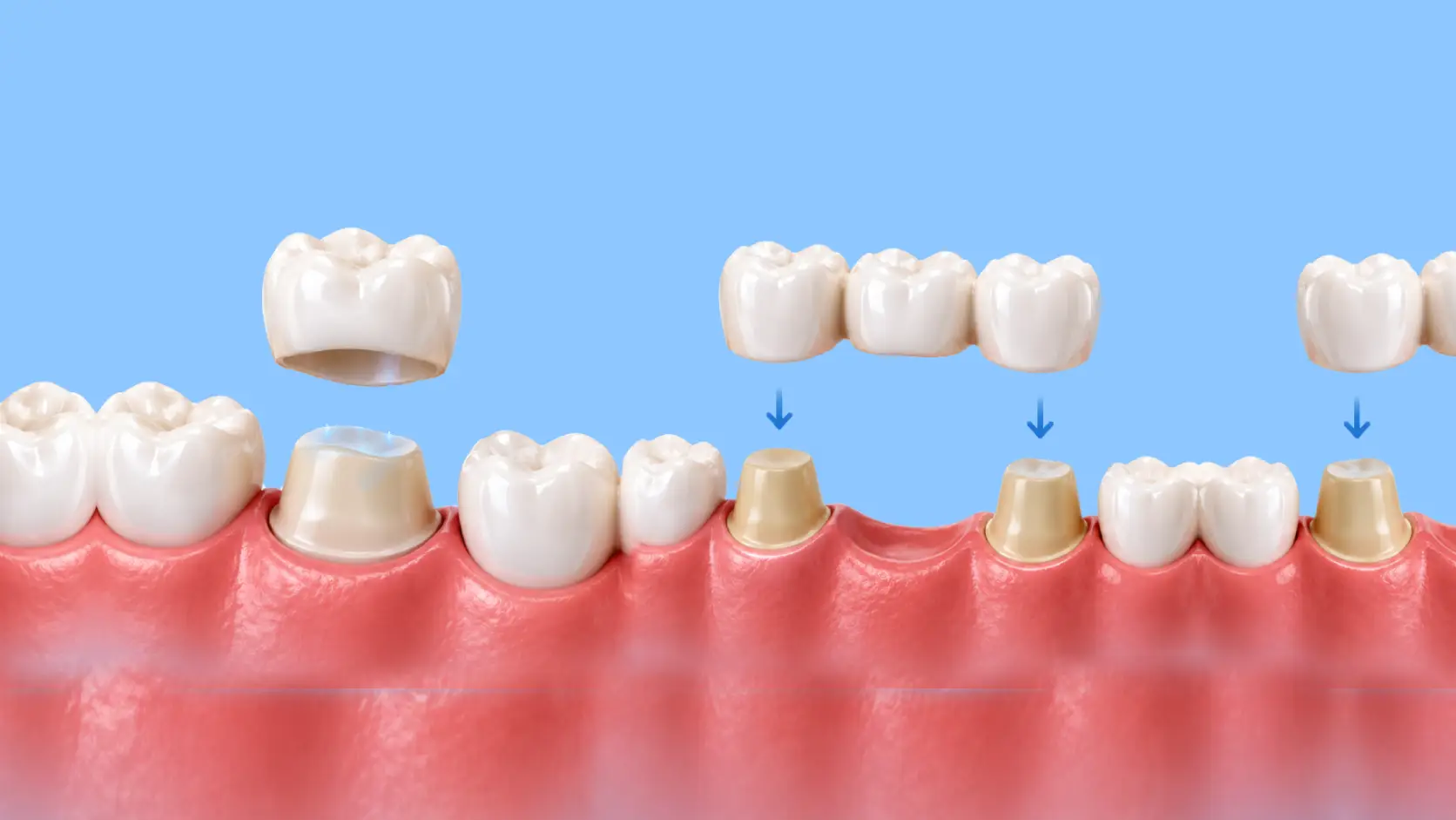 Crowns and Bridges