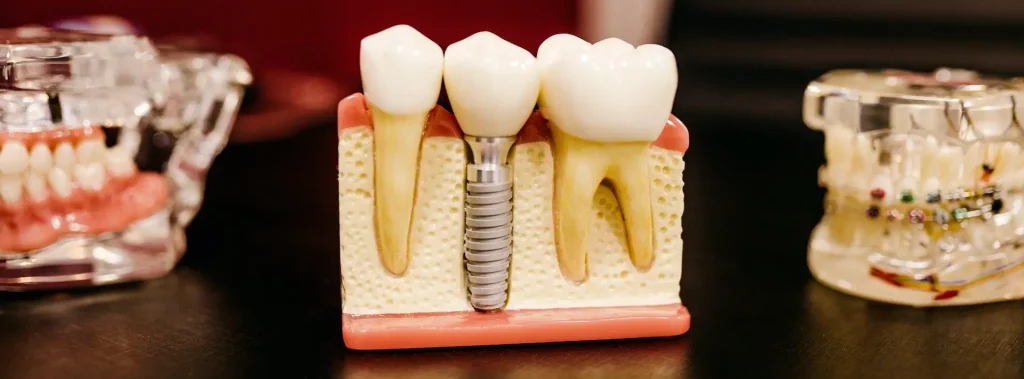 dental-implants